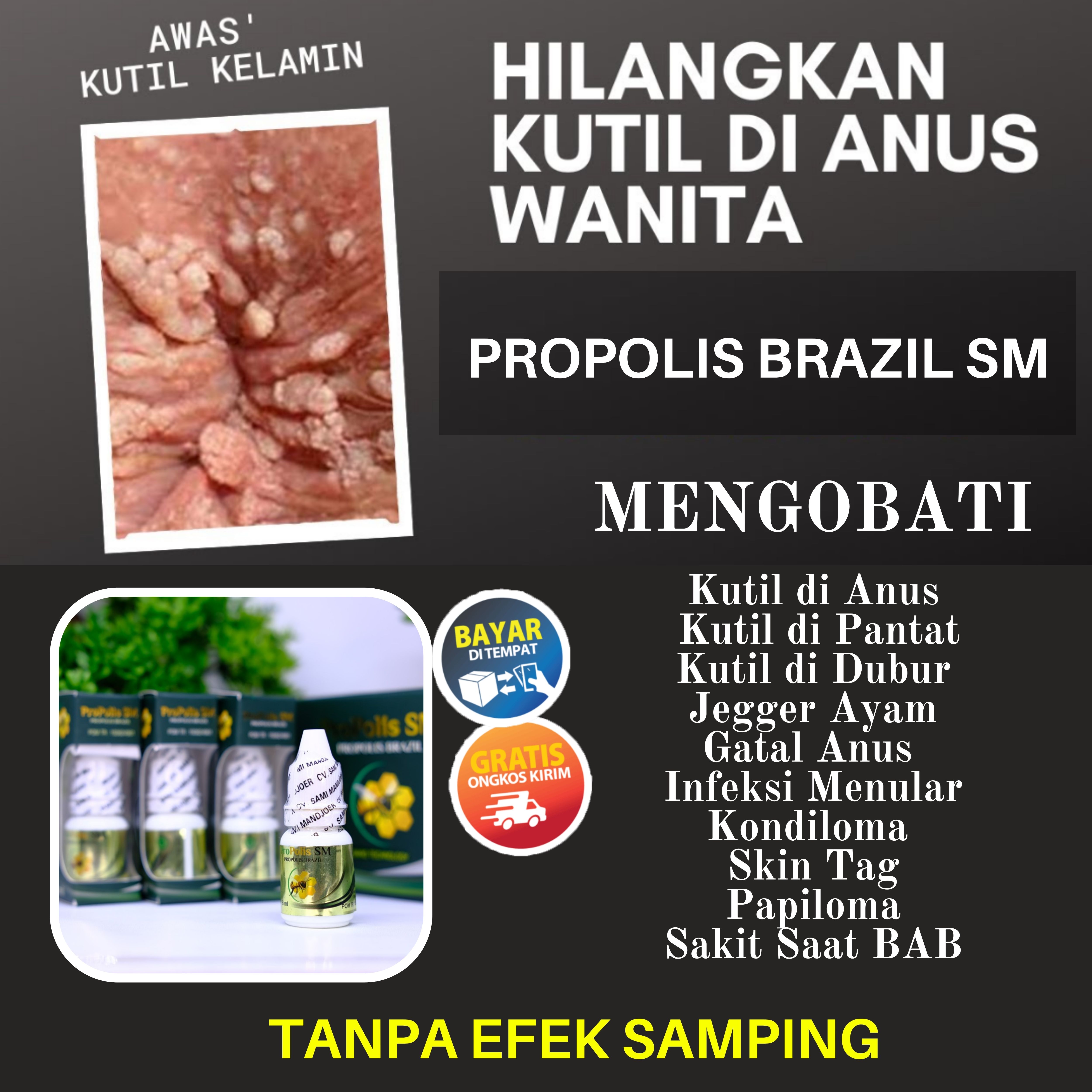 Obat menghilangkan kutil di dubur