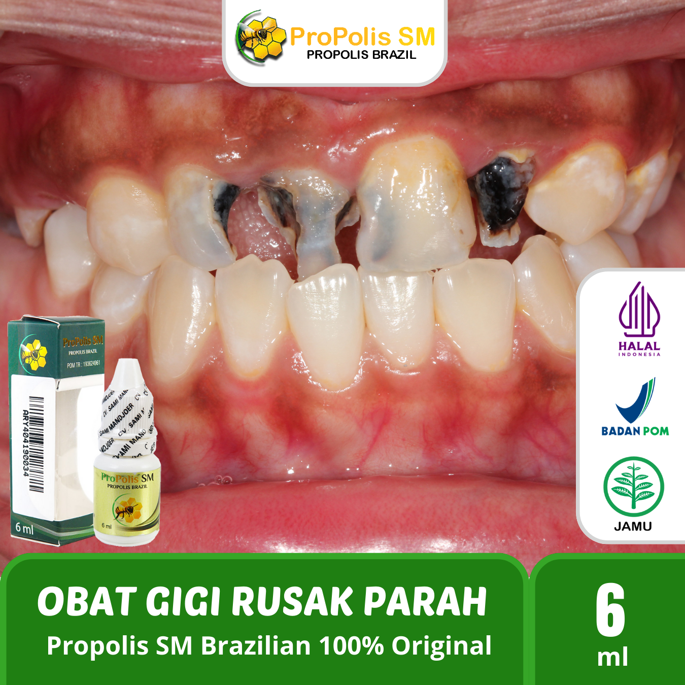 Propolis SM Brazil Asli 100% Original - Obat Gigi Rusak Parah - Obat ...