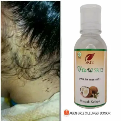 obat kutu rambut - VCO SR12 - BPOM - ORIGINAL- 100 ml(P5N7) obat kutu rambut anak paling ampuh obat kutu rambut dan telurnya obat kutu rambut ampuh obat kutu rambut anak obat kutu rambut paling ampuh obat kutu obat kutu rambut dan telurnya ampuh obat kutu