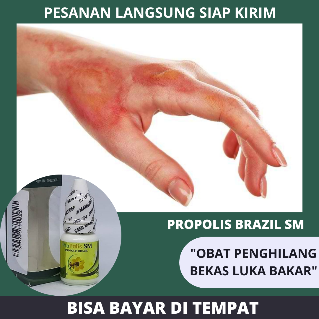 Obat Pengering Luka Tersiram Air Panas Obat Kulit Melepuh Obat Luka Air Panas Obat Tersiram Air Panas Obat Luka Bakar Obat Benjolan Di Kulit Obat Luka Lecet Obat Luka Jatuh Obat