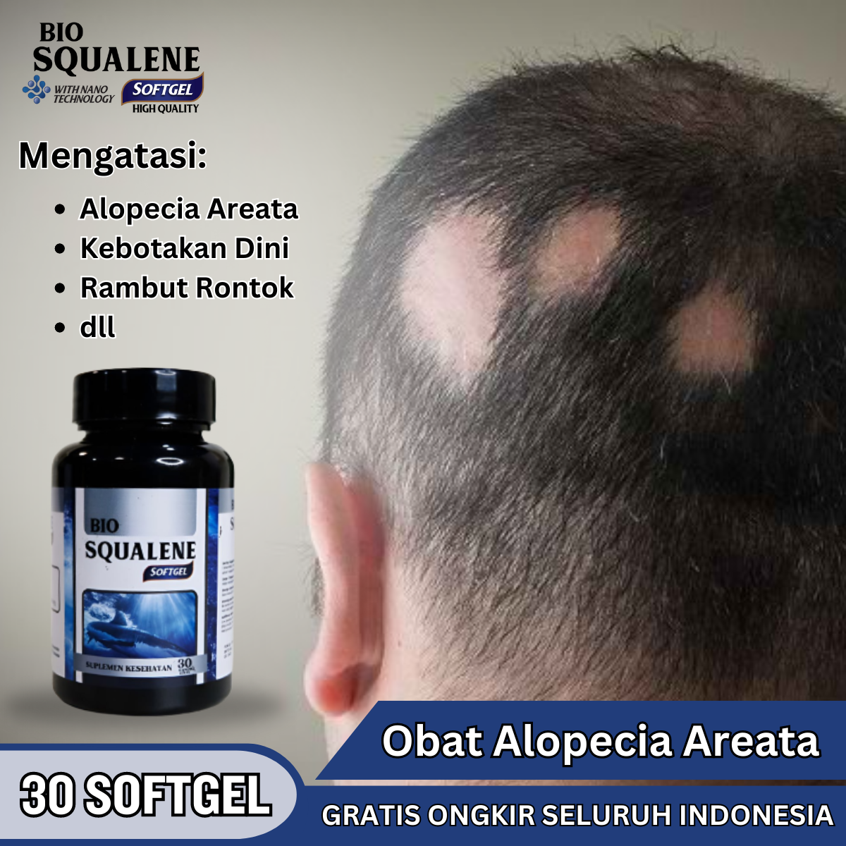 Obat Alopecia Areata, Penumbuh Rambut Botak, Penambah Rambut Rontok