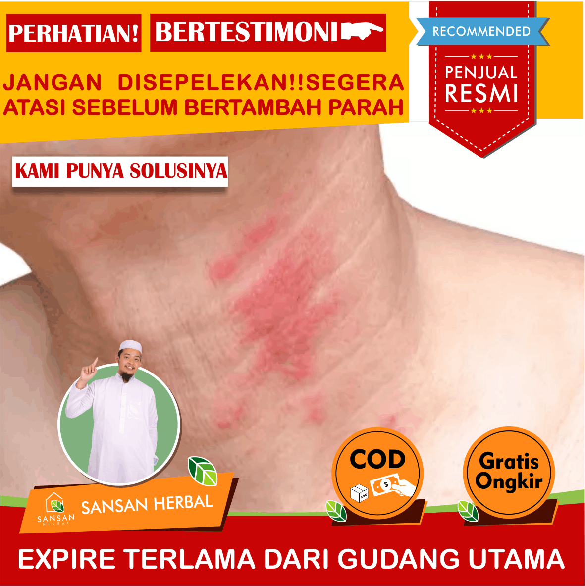 Obat dermatitis, untuk dermatitis, kulit dermatitis, gatal dermatitis