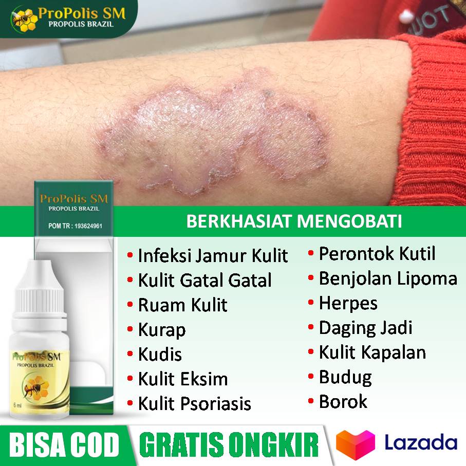 Obat Gatal Dan Jamur Pada Kulit Infeksi Jamur Kulit Jamur