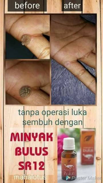Minyak Bulus Asli Obat Penghilang Tahilalat Ampuh Obat Penghilang Tahilalat Di Muka Obat Penghilang Tahilalat Hidup Obat Penghilang Tahilalat Bpom Obat Penghilang Kutil Dileher Obat Penghilang
