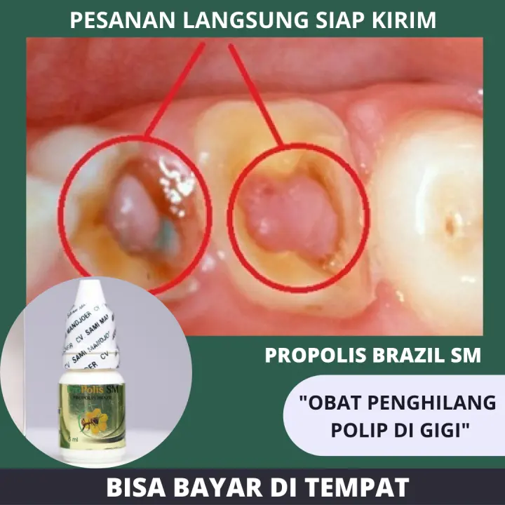 Obat Benjolan Di Dalam Gigi Obat Polip Obat Polip Hidung Obat Polip Gigi Obat Benjolan Gigi
