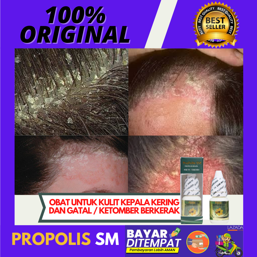 Obat Kulit Kepala Kering / Berkerak / Kulit Kepala Mengelupas / Obat
