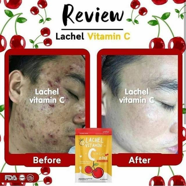 Ori Lachel Vitamin Vit C Skinest Thailand Whitening Suplemen Kapsul Obat Pemutih Jerawat Anti Acne Lazada Indonesia