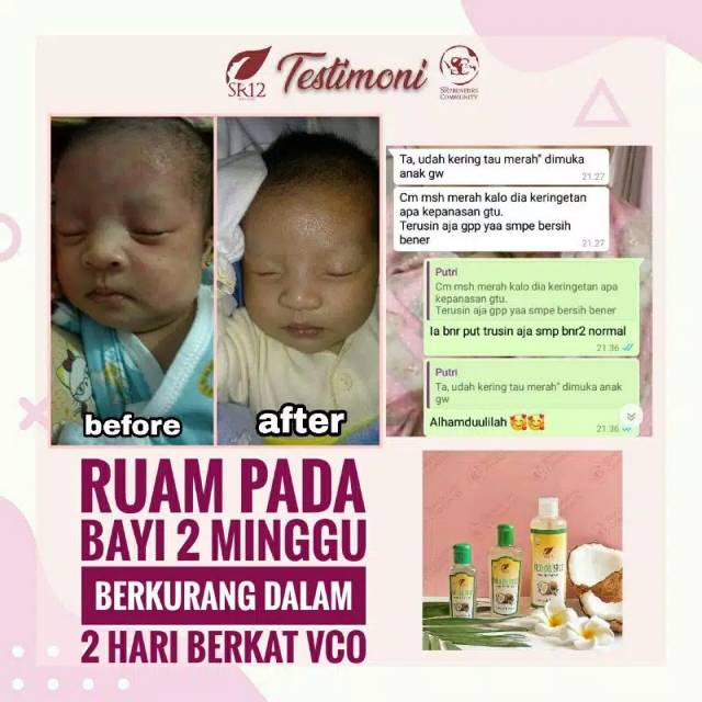 Original Vico Oil Sr12 Obat Herbal Untuk Kesehatan Bayi Solusi Ruam Popok Ruam Susu Obat Sariawan Anak Dan Bayi Lidah Putih Pada Bayi Alami Aman Bpom Lazada Indonesia