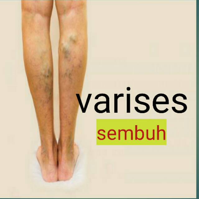 Obat Varises Lazada Indonesia