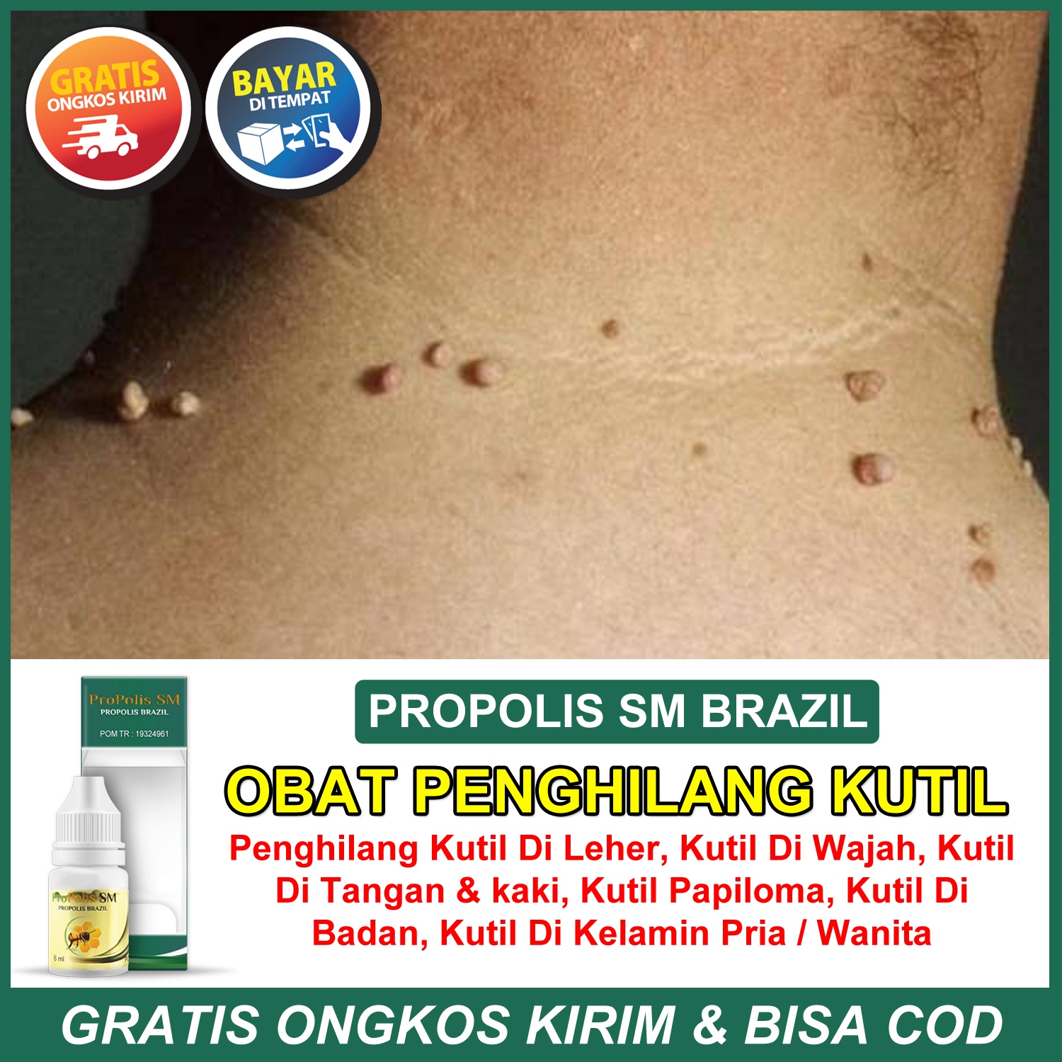 Obat Kutil Obat Kutil Papiloma Obat Kutil Di Leher Salep Untuk Menghilangkan Kutil Obat Kutil Kelamin Obat Perontok Kutil Obat Daging Tumbuh Obat Bintitan Mata
