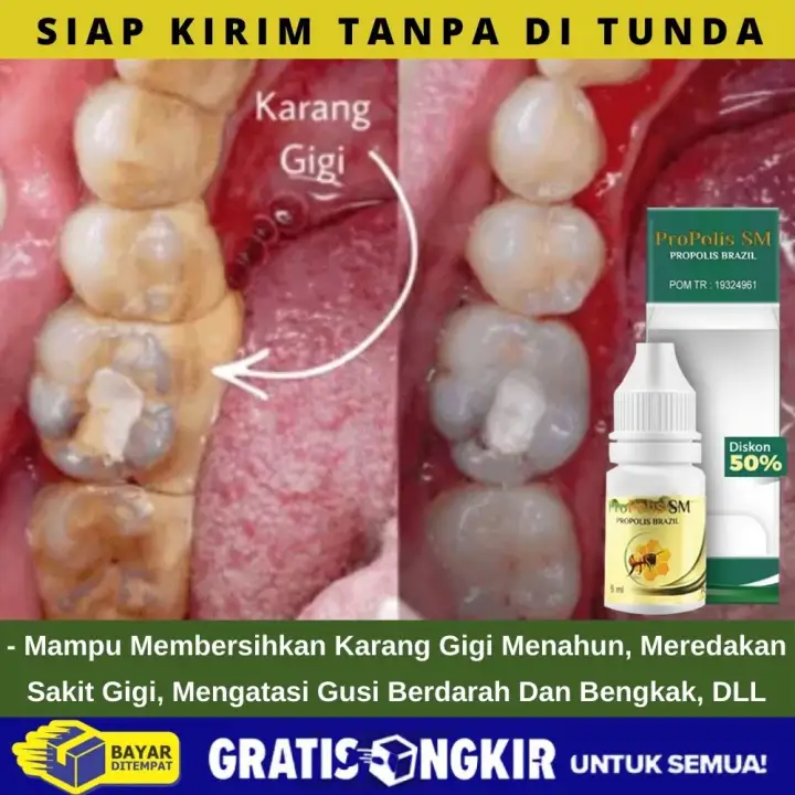 Obat Herbal Gigi Berlubang Obat Gigi Ngilu Gigi Bengkak Berdarah Meredakan Gusi Bengkak Menahun Menghilangkan Sakit