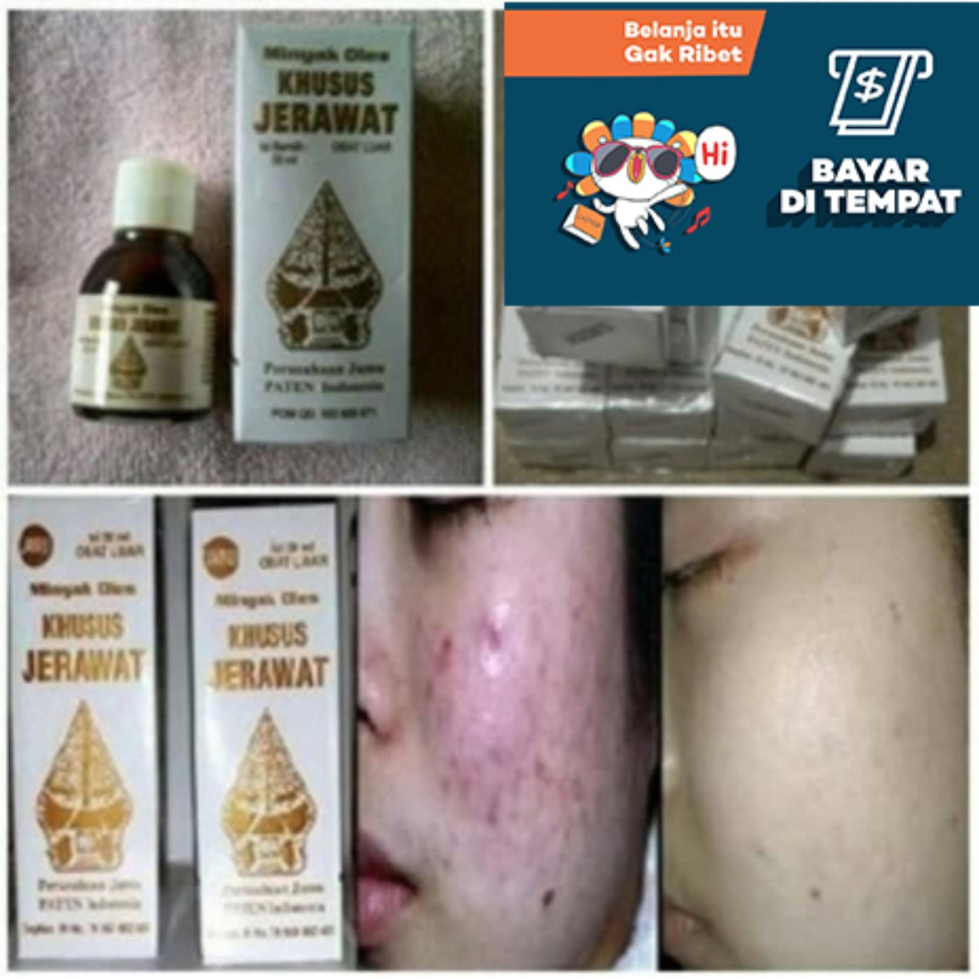 Cap Wayang Minyak Oles Jerawat ASLI 100% Original, Wayang Minyak Oles Khusus Jerawat Ampuh Anti Acne, Obat Herbal Alami Tradisional Obati Jerawat Bisul Wajah Bernanah Kulit Halus Segar Berseri, Produk Perwatan Kulit Face Skin Beauty, Obat Jerawat Ampuh
