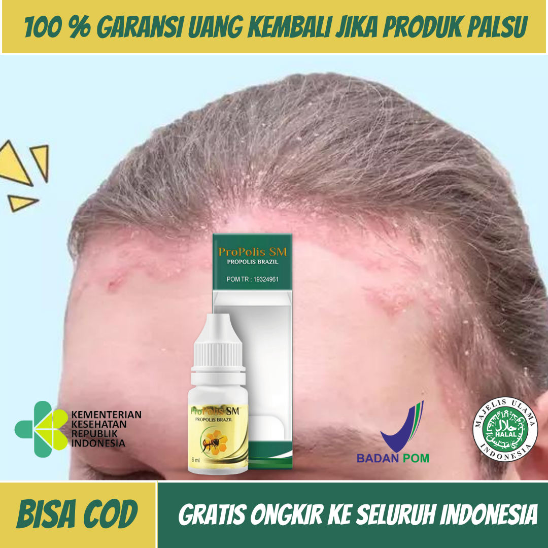 Obat Psoriasis Kulit Kepala, Obat Kulit Kepala Berkerak, Obat Ketombe