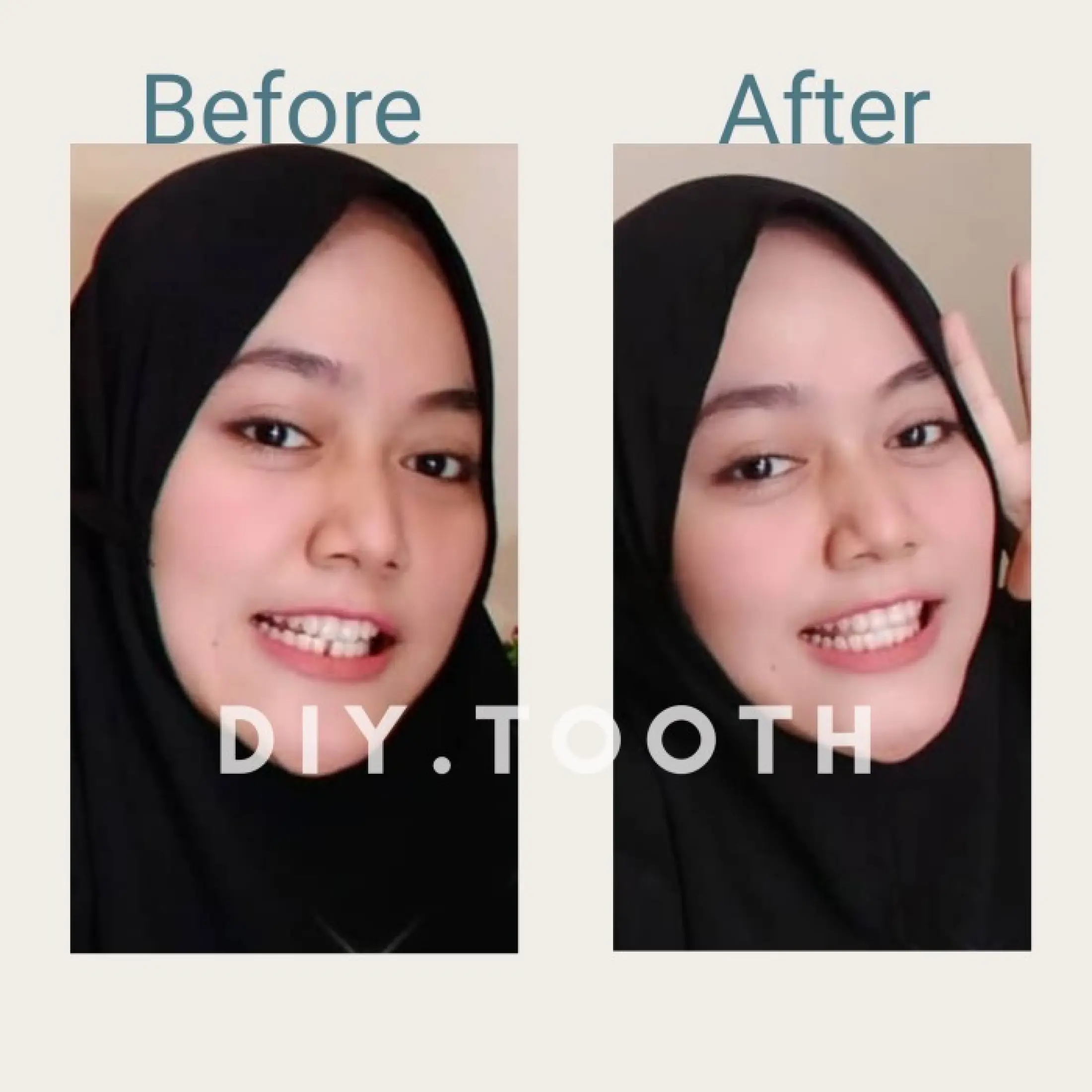Terlaris Sedang Diskon Gigi Palsu Temptooth Temporary Tooth Lem Tambal Gigi Instan Kuat Untuk Memperbaiki Gigi Berlubang Ompong Patah Gigi Renggang Bisa Bentuk Gigi Kelinci Bisa Cod Lazada Indonesia