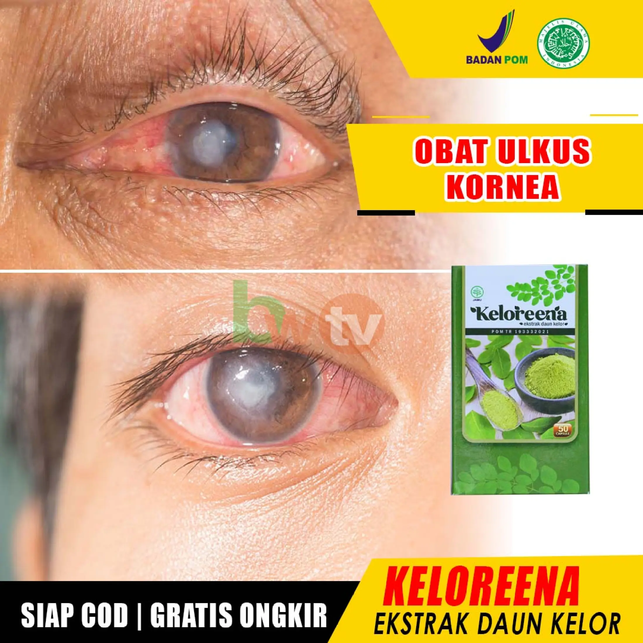 Obat Ulkus Kornea Kornea Mata Luka Luka Pada Mata Cedera Mata Bercak Putih Keratitis Bintik Putih Infeksi Kornea Mata Katarak Penglihatan Kurang Jelas