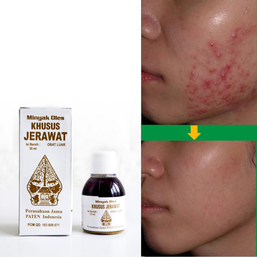 Obat Jerawat Herbal Minyak Oles Alami Khusus Jerawat Cap Wayang Lazada Indonesia