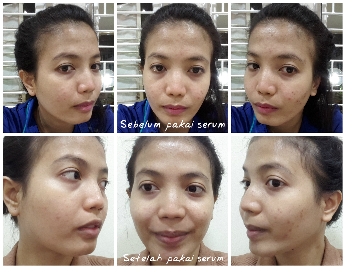 testi serum scarlett acne