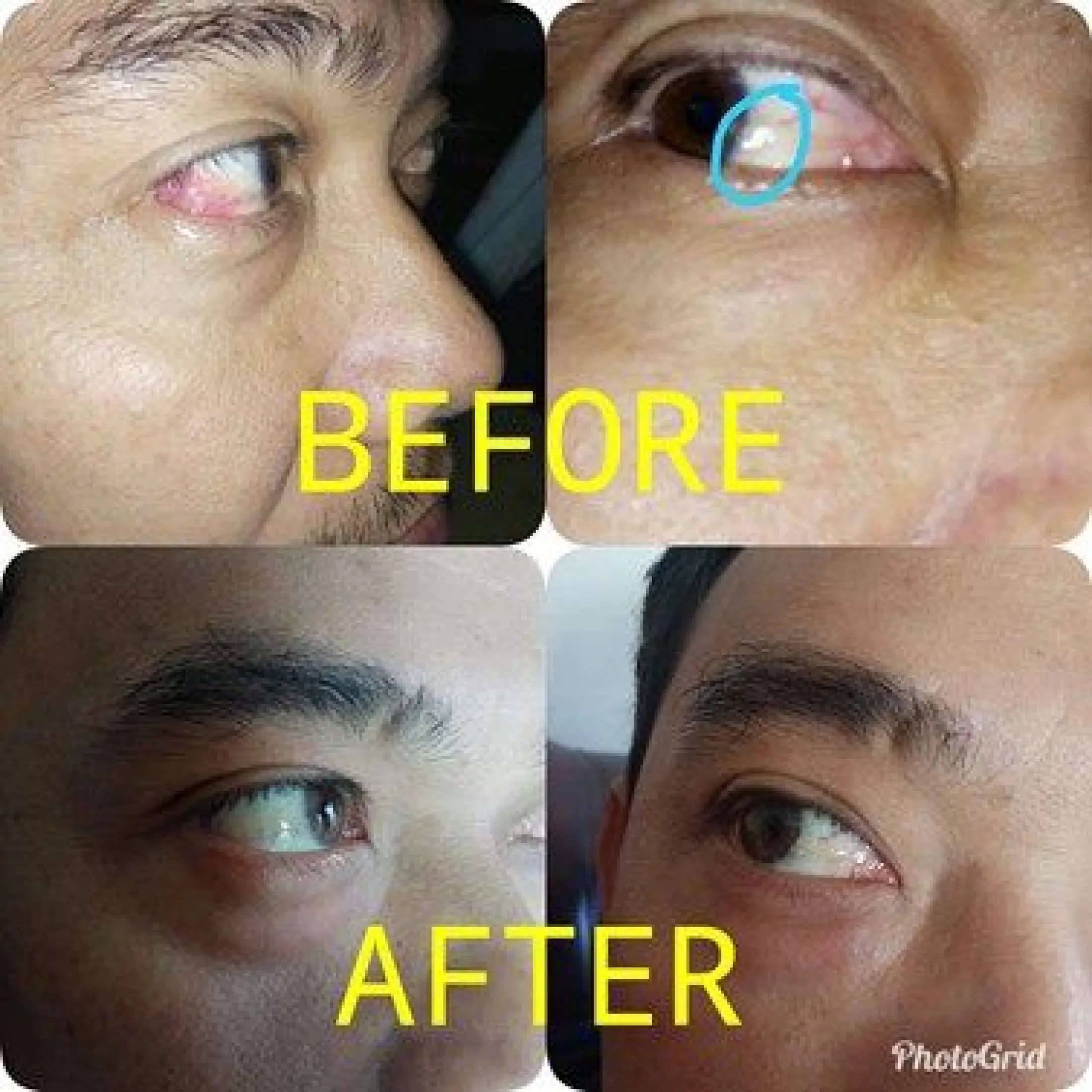 Obat Untuk Pterygium Mata Obat Mata Berlemak Obat Mata Berkabut Obat Herbal Jamu Keloreena Vitamin Kesehatan Mata Obat Pencerah Mata Keloreena 100 Ekstrak Daun Kelor Original Lazada Indonesia